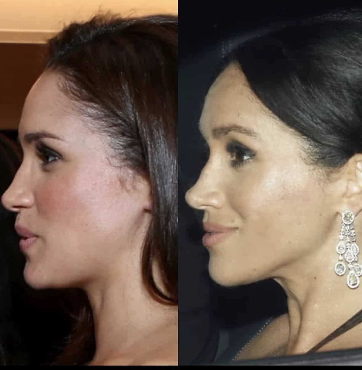 Hur mycket plastikkirurgi gjorde Megan Markle?