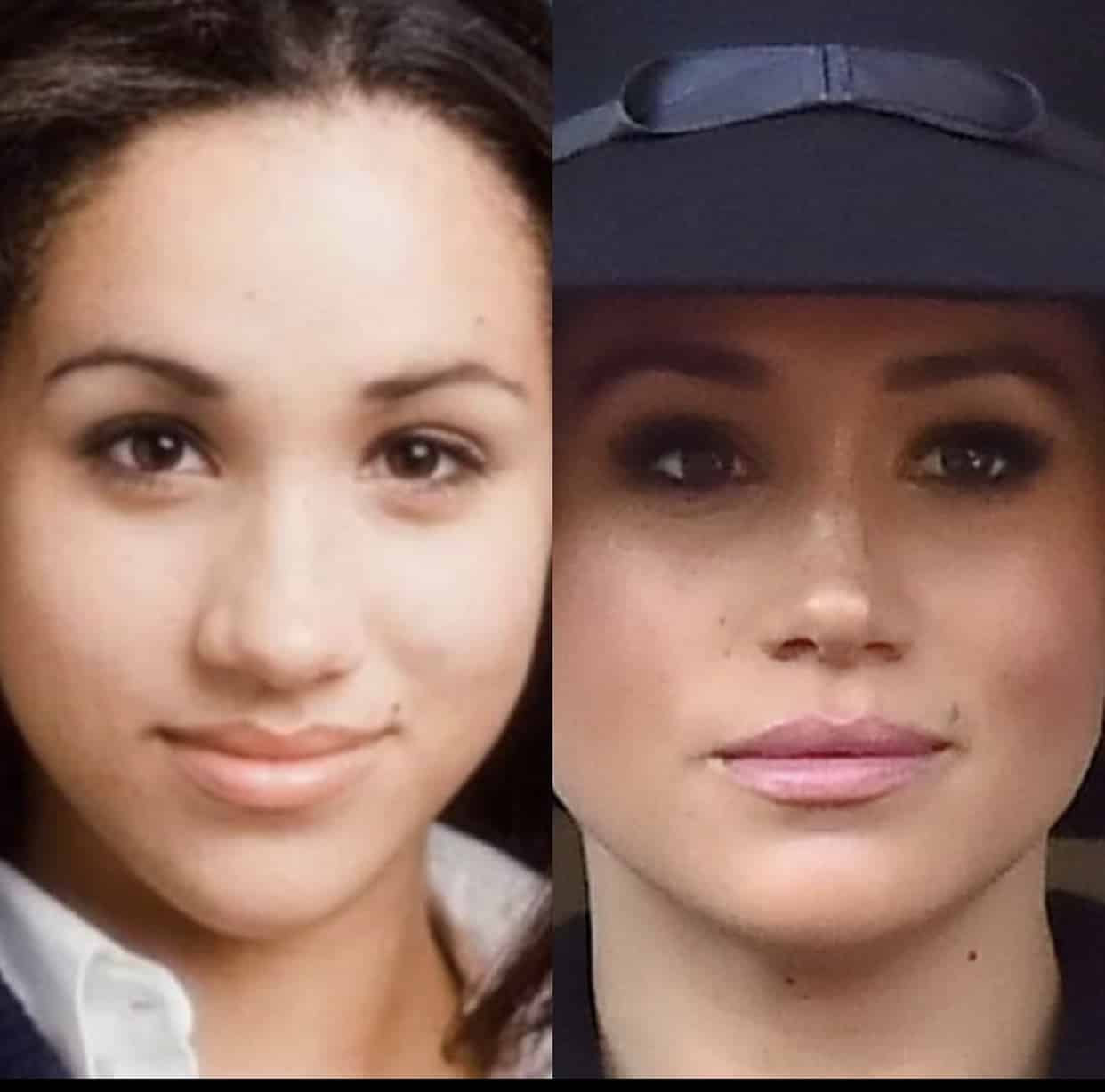 Kiom da plastika kirurgio faris Megan Markle?