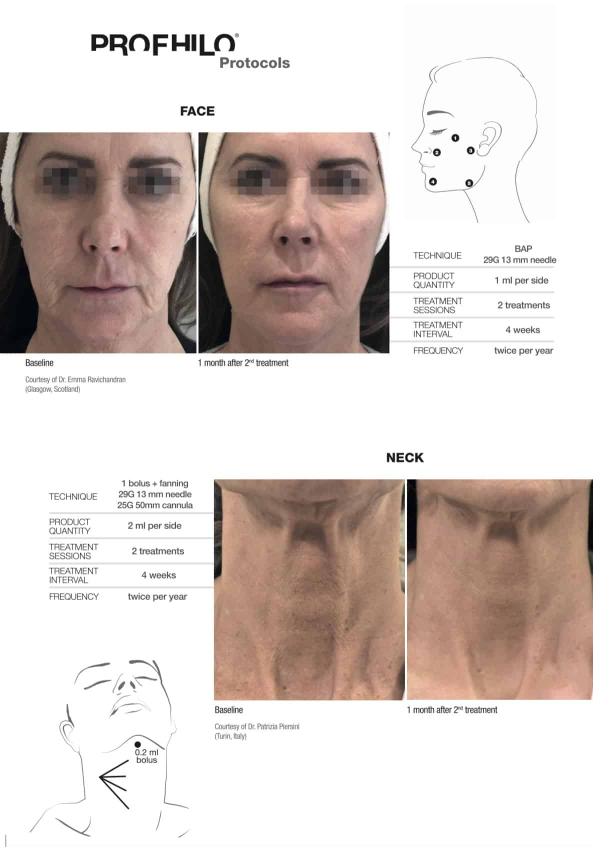 Profilo injection before after