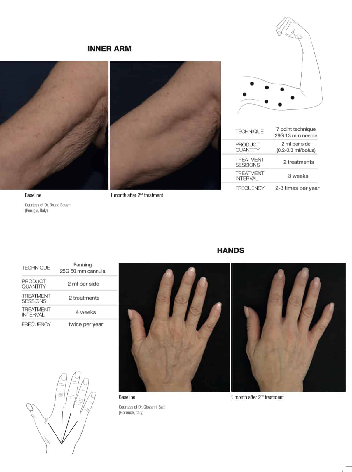 Profilo injection before after