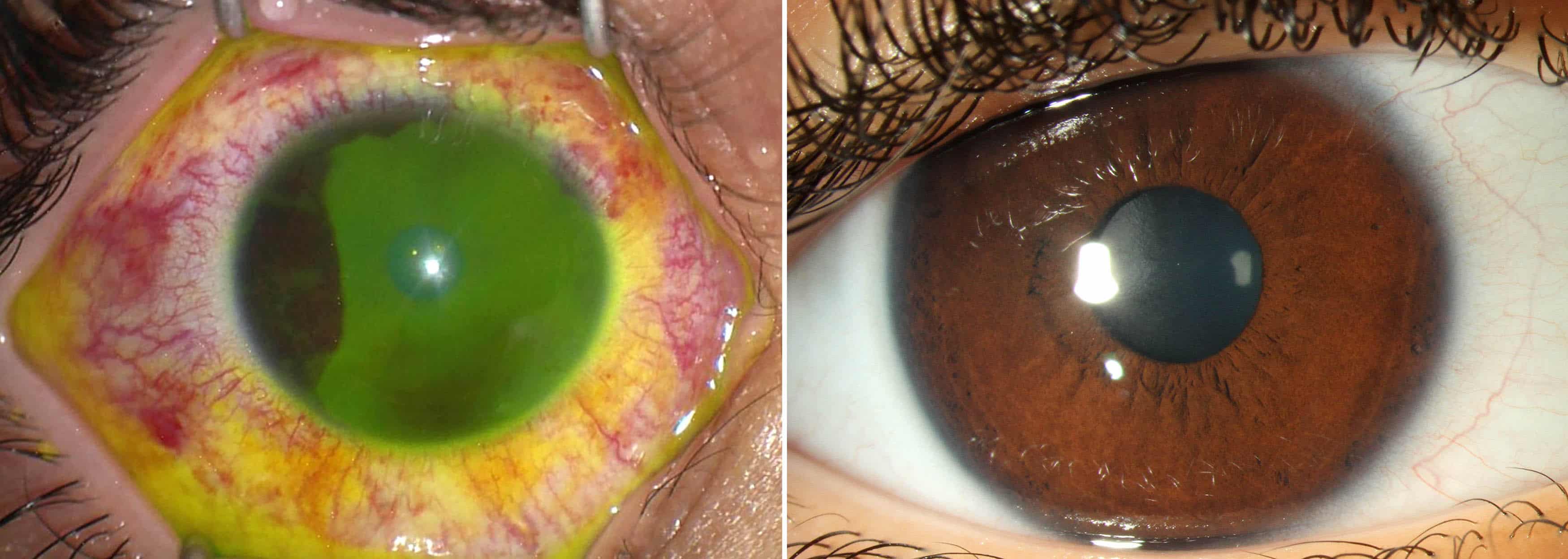 Odborníci varujú, že dezinfekčné prostriedky na ruky môžu u detí viesť k vážnym poraneniam očí