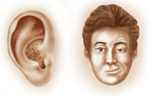 Ramsay Hunt syndrome