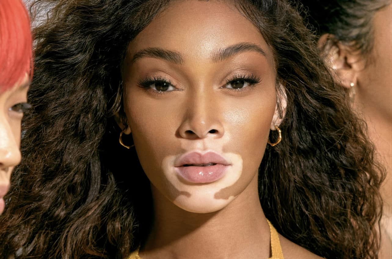 Trattamentu novu per u vitiligo