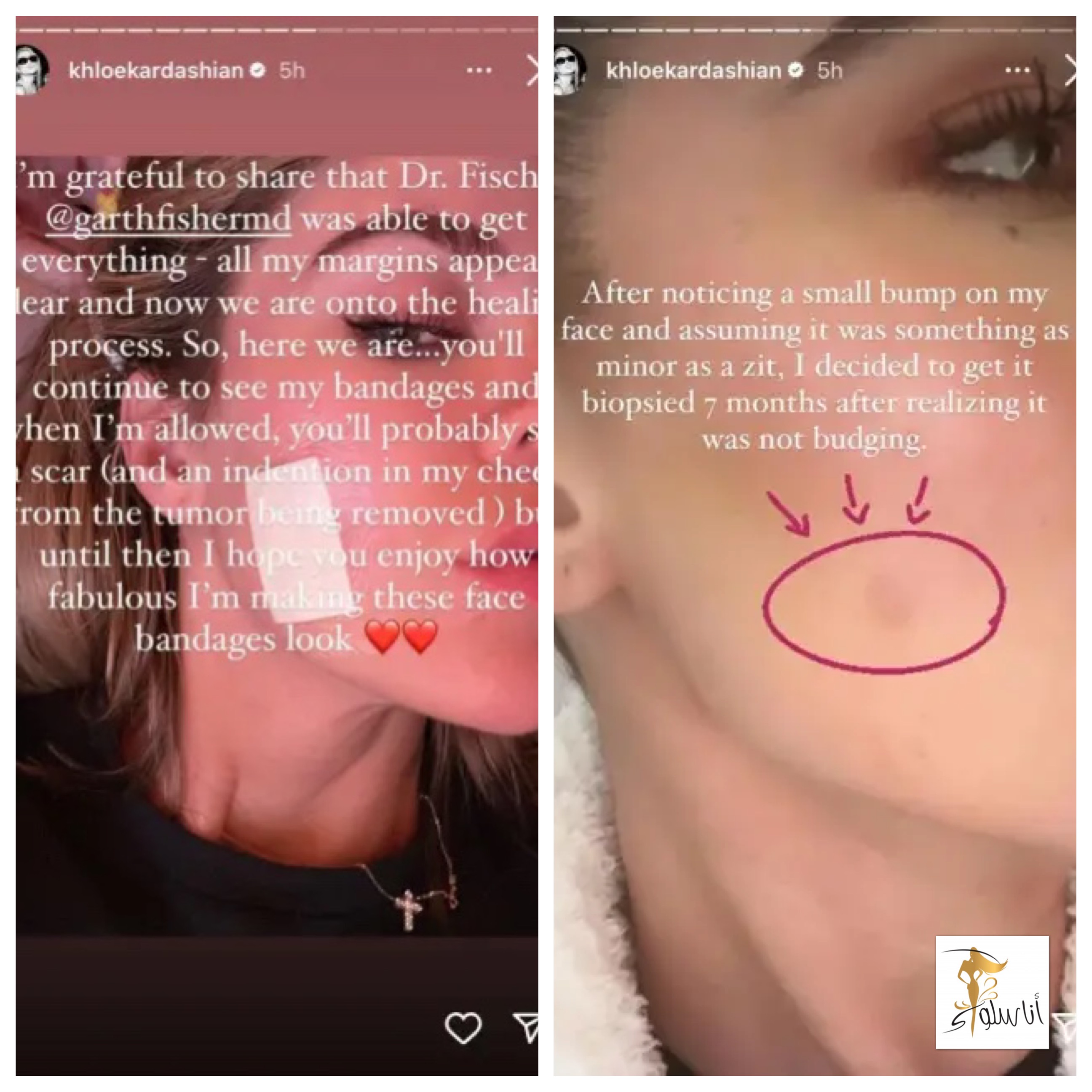 khloe kardashian kansarka