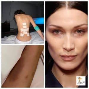 Les contusions de Bella Hadid