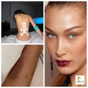 Οι μώλωπες της Bella Hadid