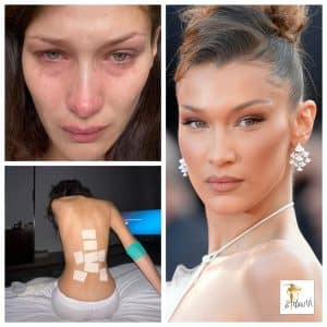 Sëmundja Bella Hadid