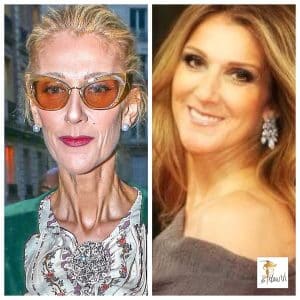 Celine Dion har tidligere lidt af symptomerne